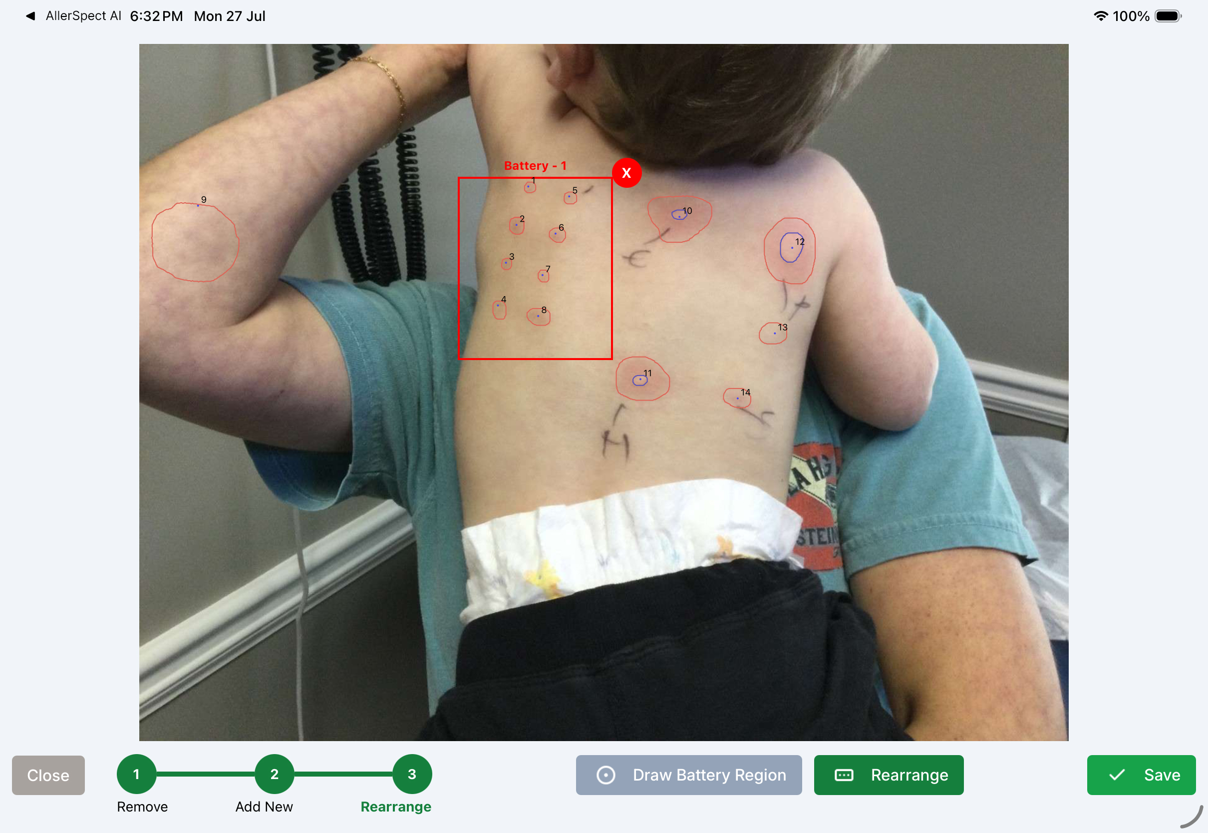 AllerSpect AI Clinical Skin Test Measurement